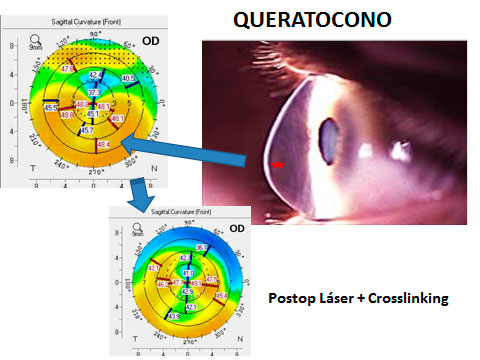 Queratocono donde se observa la deformación de la córnea (estrella roja) con la imagen característica de la topografía (color anaranjado de la zona inferior) y como cambia después del tratamiento con láser y crosslinking (se regulariza la curvatura corneal).