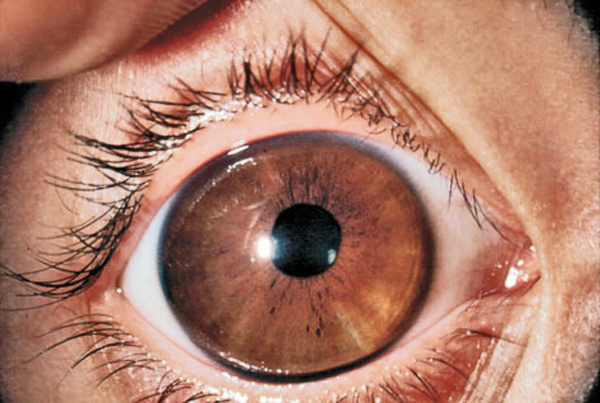 La megalocórnea es una enfermedad del ojo que consiste en la existencia de una córnea aumentada de tamaño que presenta un diámetro superior a los 13 mm